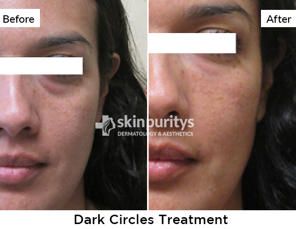Dark Circles results